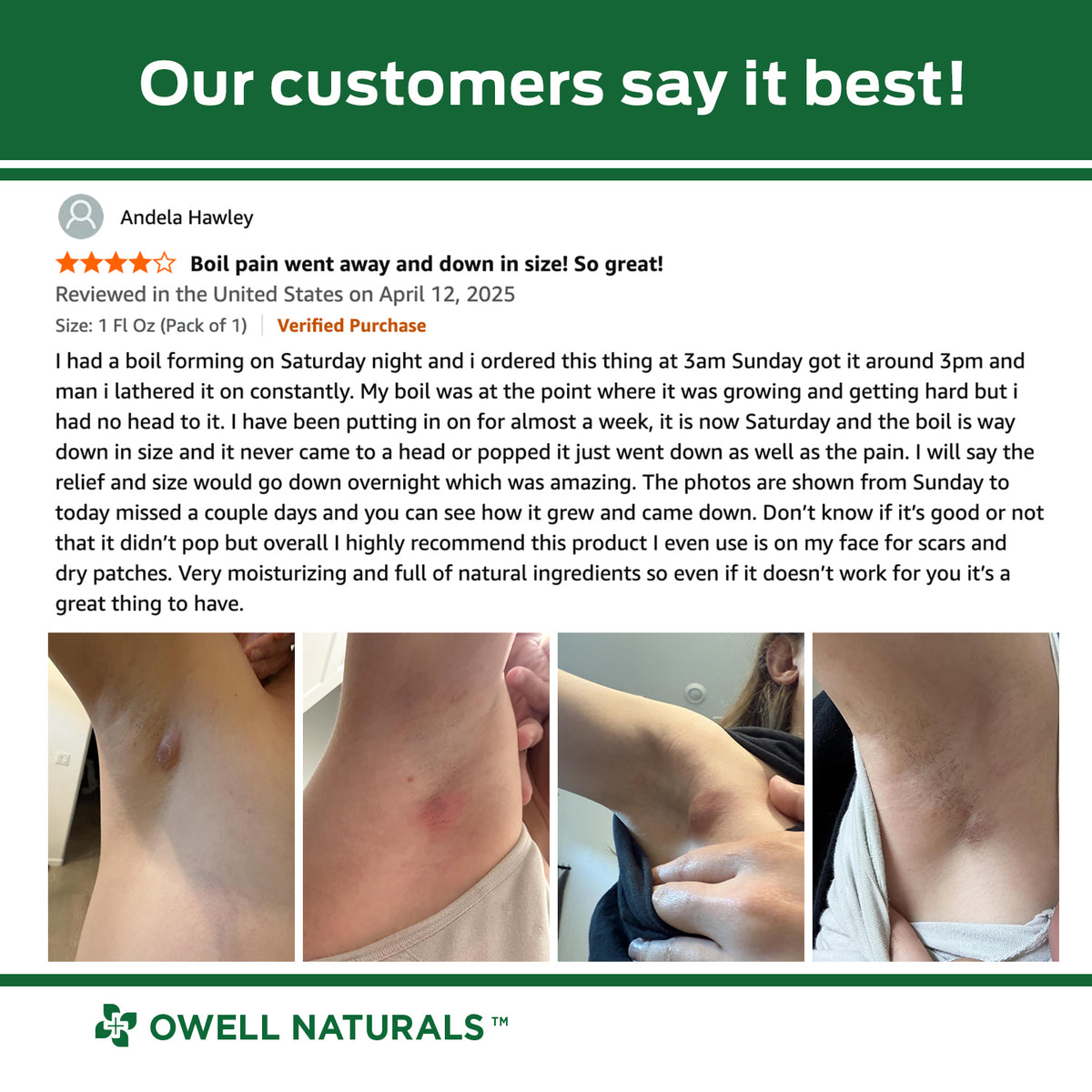 OWELL NATURALS Drawing Salve Ointment 1oz, ingrown Hair Treatment, Boil & Cyst, Splinter Remover, Bug and Spider Bites, bee Sting, Mosquito bite Itch Relief, Poison Ivy